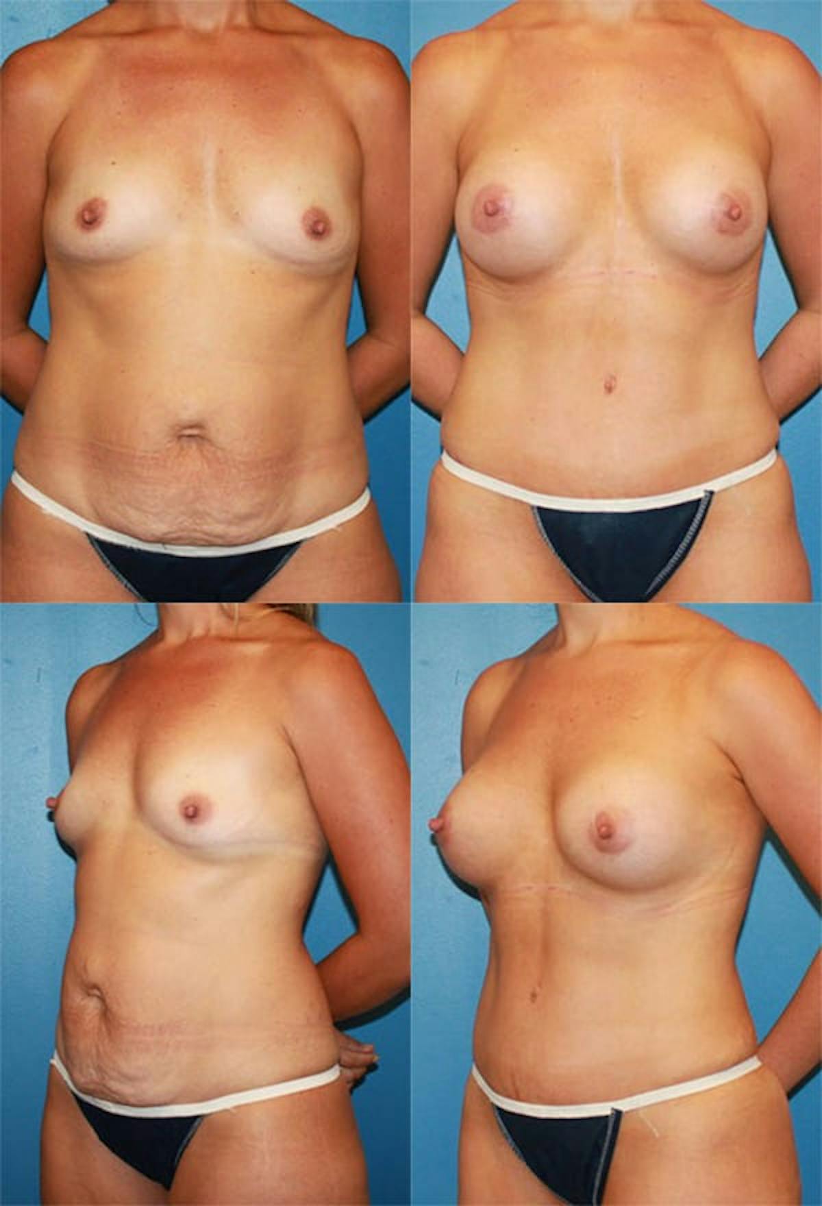 Tummy Tuck Before & After Gallery - Patient 416037 - Image 1
