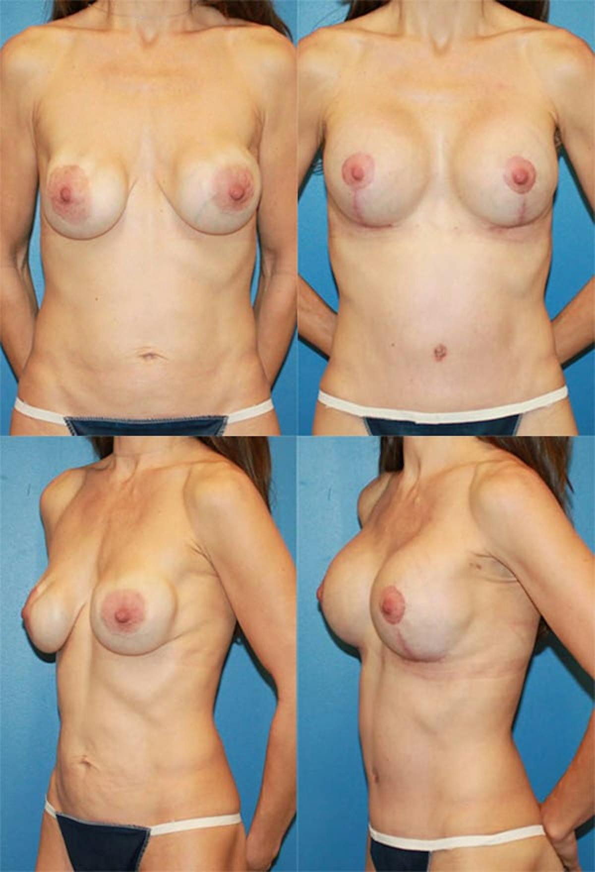 Mommy Makeover Before & After Gallery - Patient 280767 - Image 1