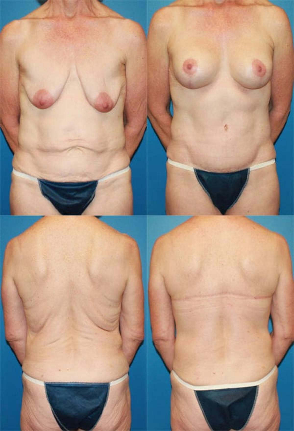 Mommy Makeover Before & After Gallery - Patient 369945 - Image 1