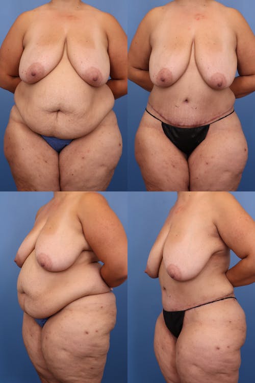 Patient 3 Before - Tummy Tuck