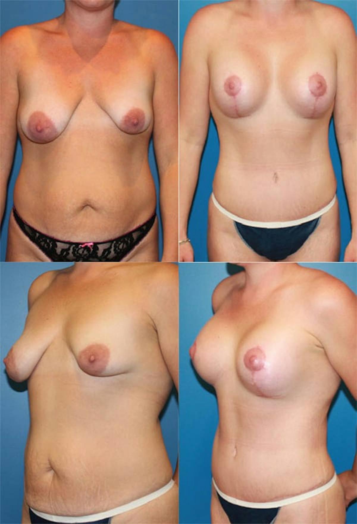 Mommy Makeover Before & After Gallery - Patient 327339 - Image 1