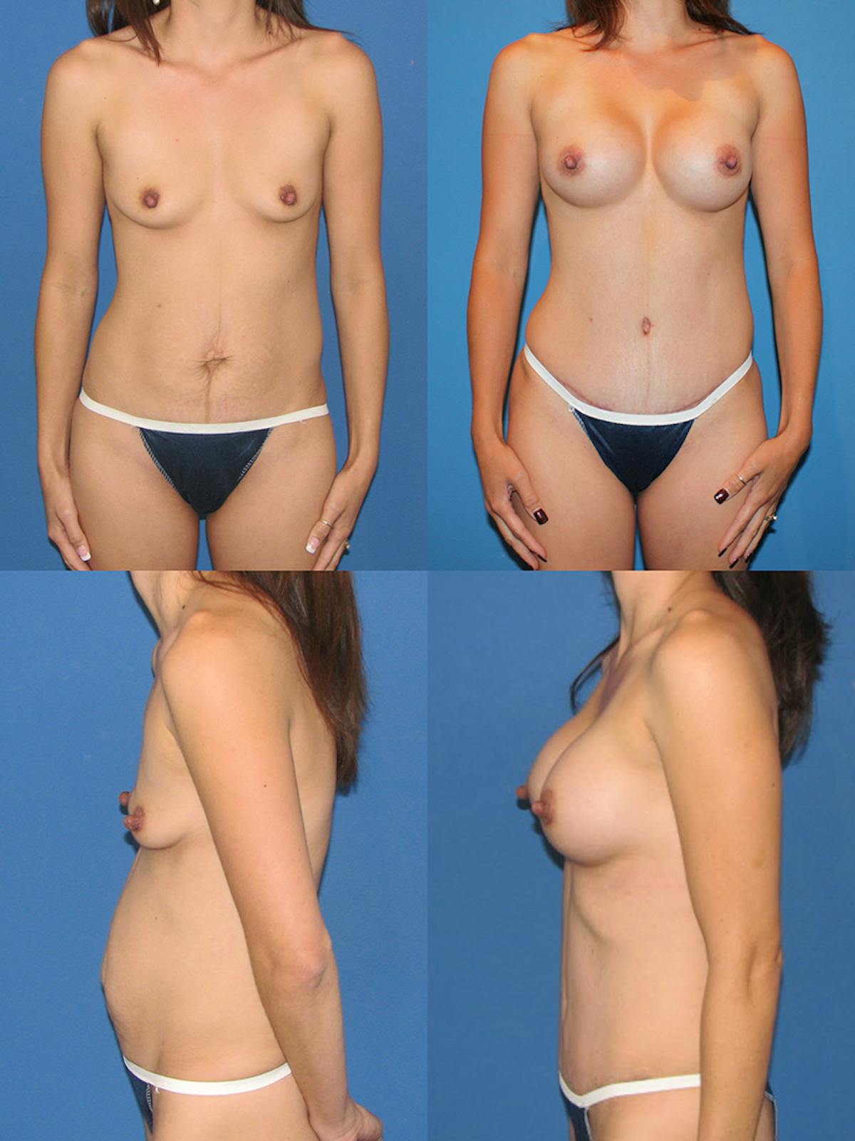 Mommy Makeover Before & After Gallery - Patient 329679 - Image 1