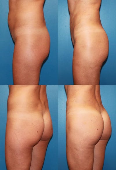 Brazilian Butt Lift Before & After Gallery - Patient 398138 - Image 1