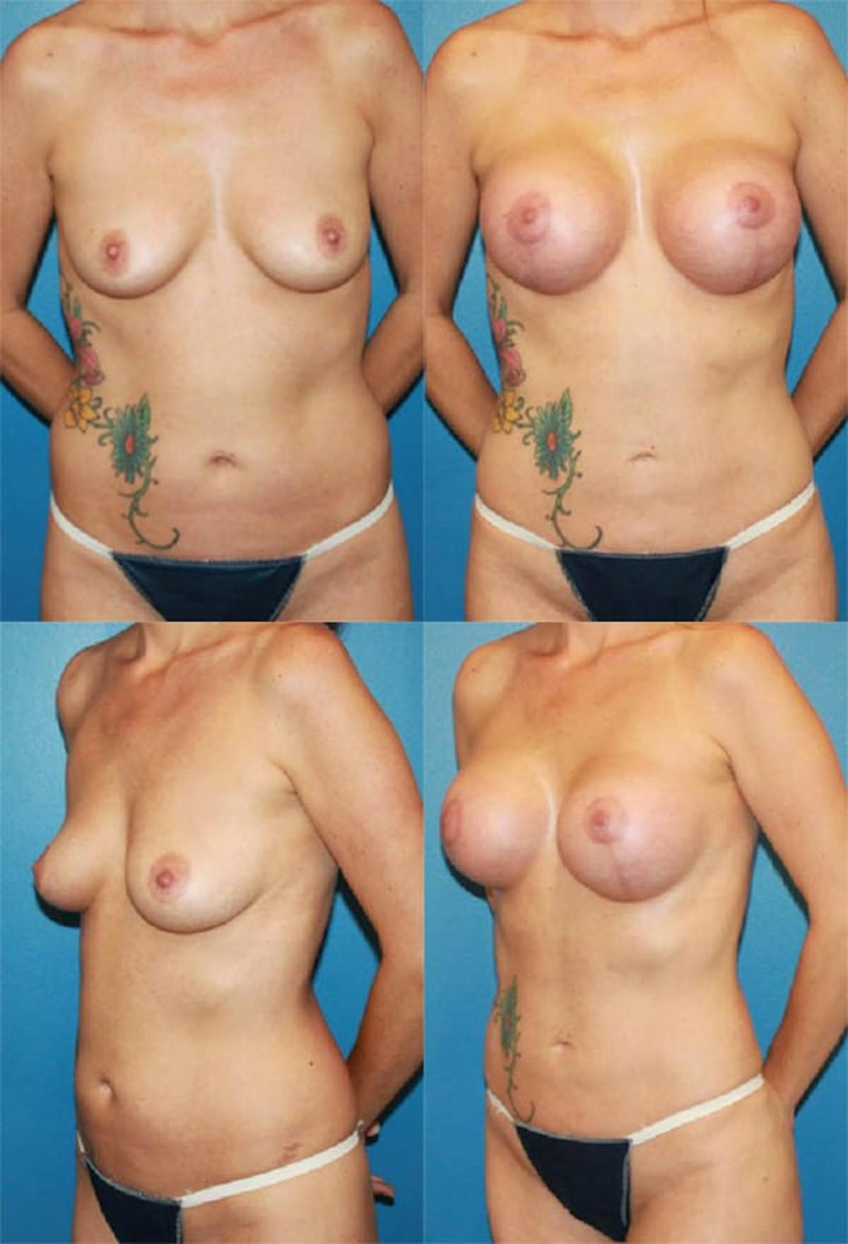 Mommy Makeover Before & After Gallery - Patient 418749 - Image 1