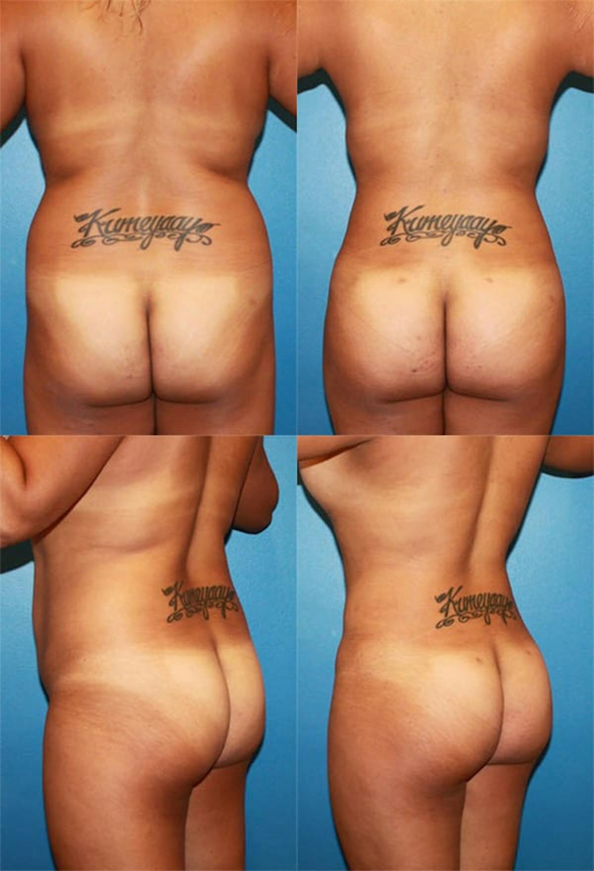 Brazilian Butt Lift Before & After Gallery - Patient 186362 - Image 1