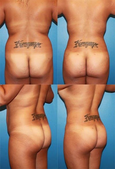 Brazilian Butt Lift Before & After Gallery - Patient 186362 - Image 1