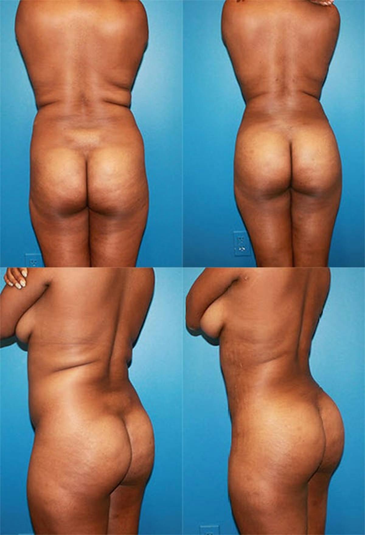 Brazilian Butt Lift Before & After Gallery - Patient 609023 - Image 1