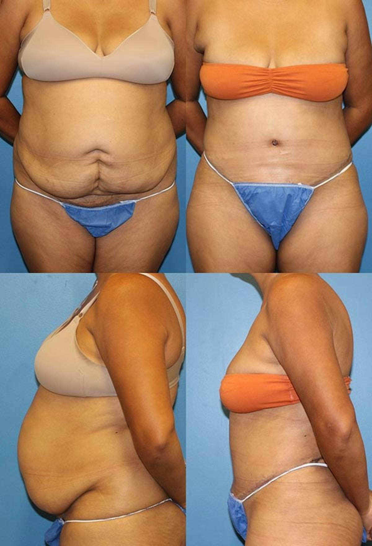 Tummy Tuck Before & After Gallery - Patient 389447 - Image 1