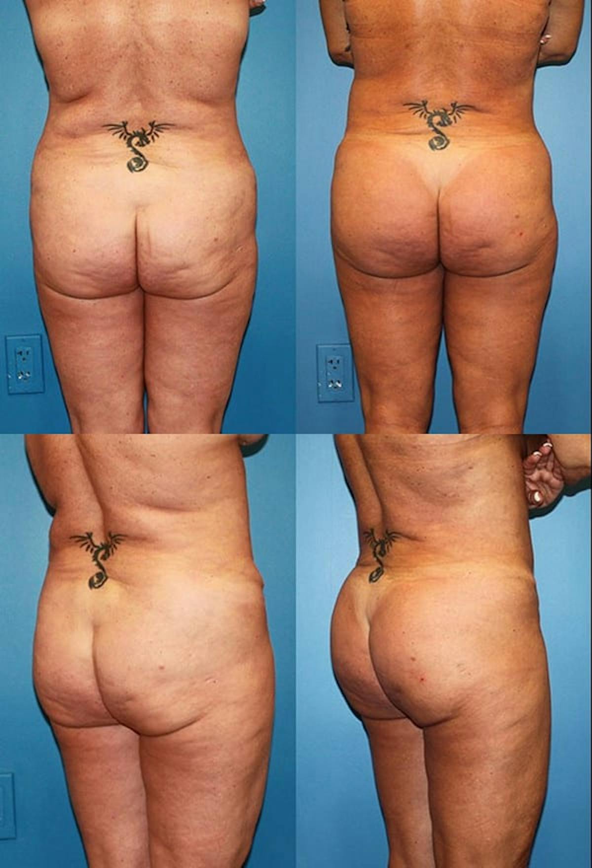 Brazilian Butt Lift Before & After Gallery - Patient 740471 - Image 1