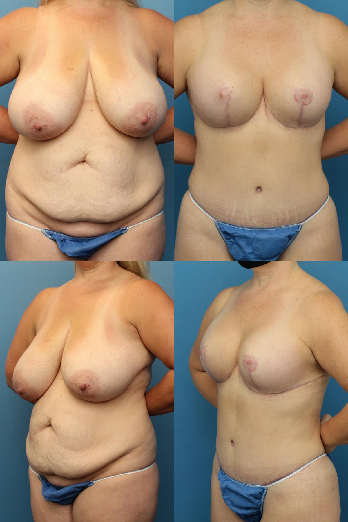 Mommy Makeover Before & After Gallery - Patient 401341 - Image 1