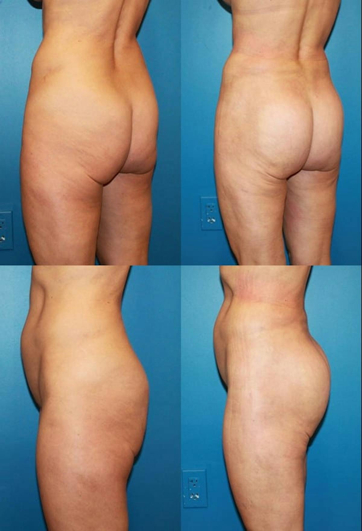 Brazilian Butt Lift Before & After Gallery - Patient 376829 - Image 1