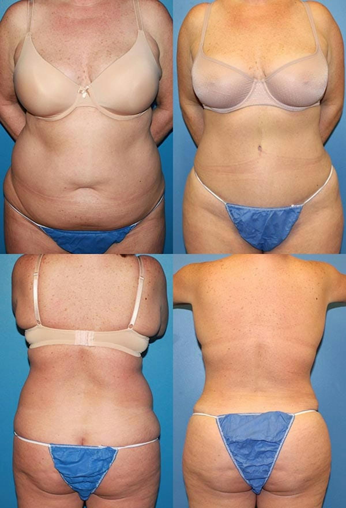 Tummy Tuck Before & After Gallery - Patient 183953 - Image 1