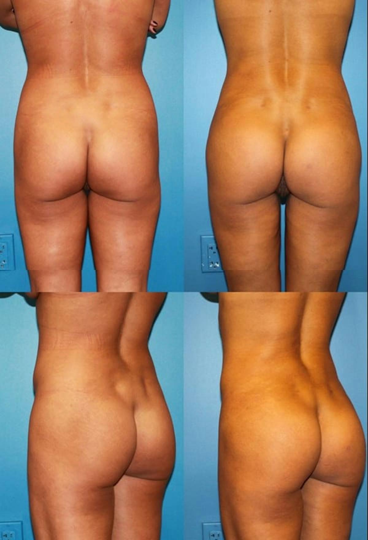 Brazilian Butt Lift Before & After Gallery - Patient 235093 - Image 1