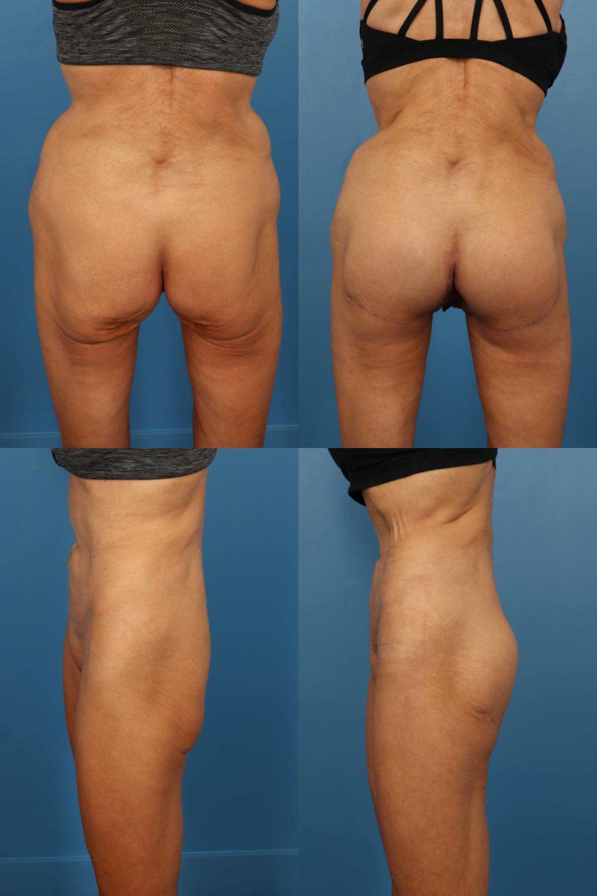 Buttock Augmentation with Implants Before & After Gallery - Patient 205177 - Image 1