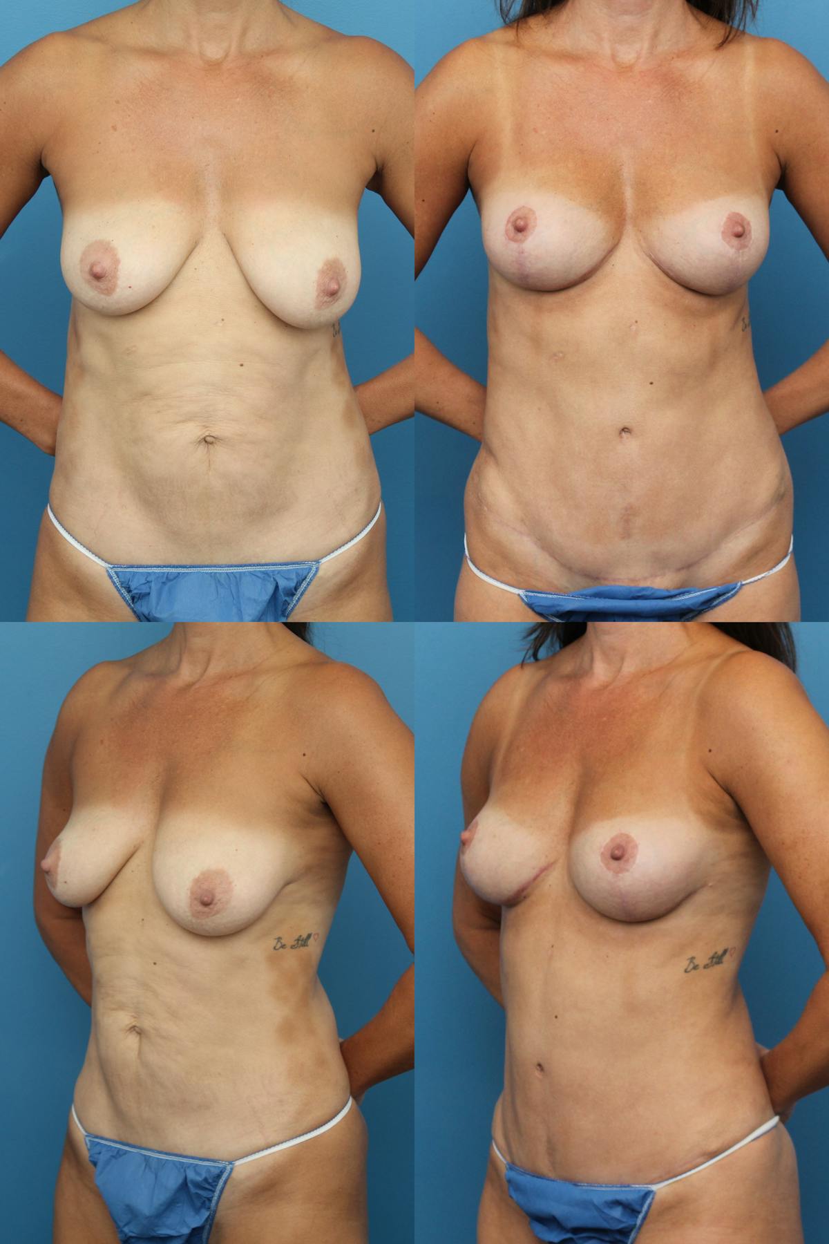 Mommy Makeover Before & After Gallery - Patient 218250 - Image 1