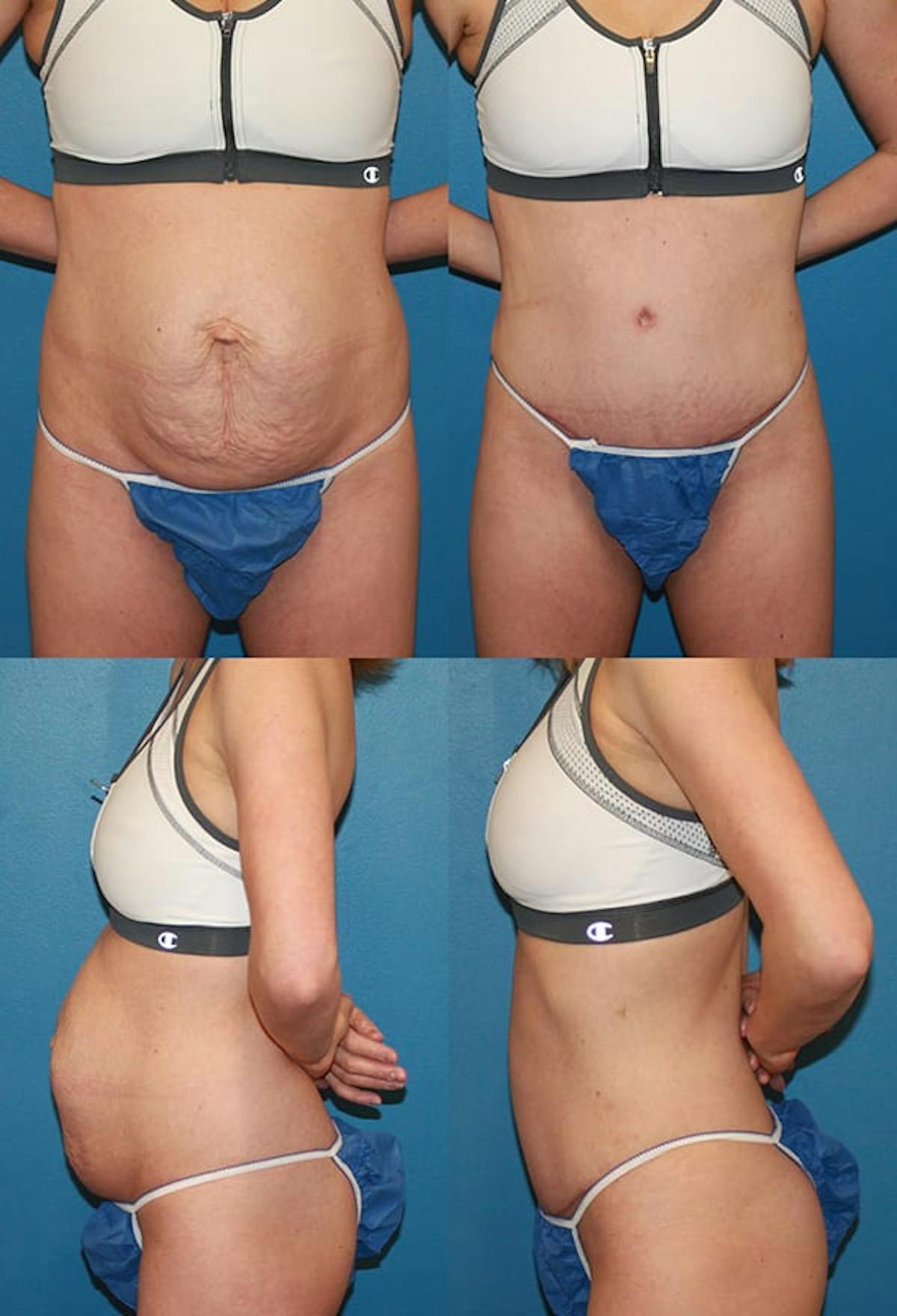 Tummy Tuck Before & After Gallery - Patient 823827 - Image 1