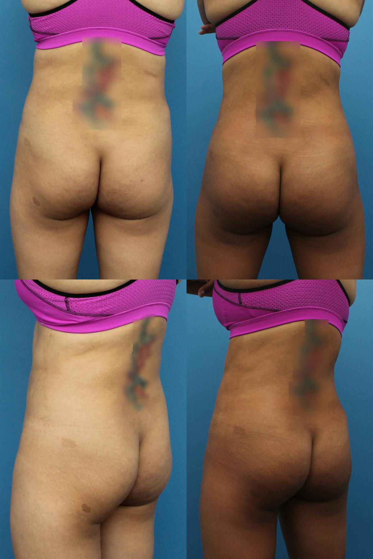 Brazilian Butt Lift Before & After Gallery - Patient 178565 - Image 1