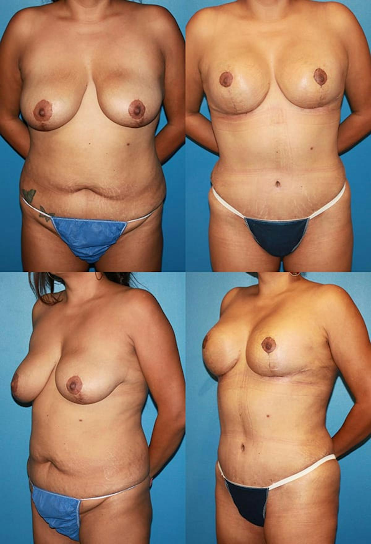 Tummy Tuck Before & After Gallery - Patient 118696 - Image 1