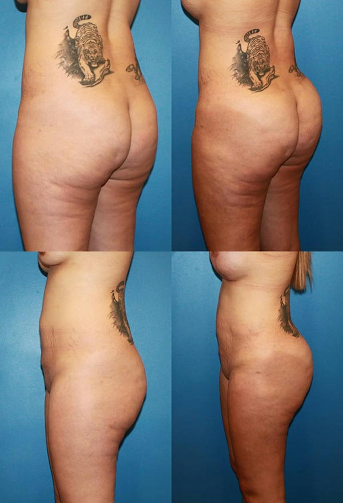 Brazilian Butt Lift Before & After Gallery - Patient 196039 - Image 1