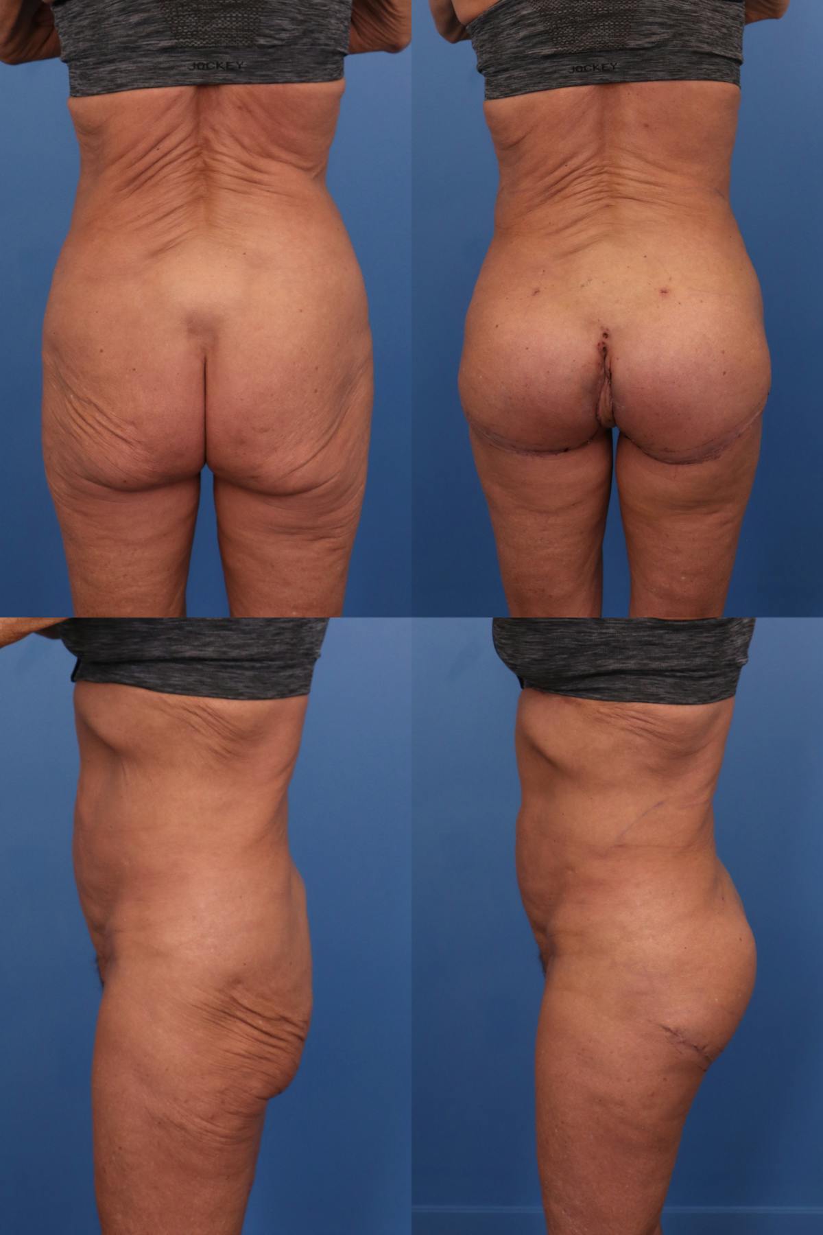Buttock Augmentation with Implants Before & After Gallery - Patient 155570 - Image 1