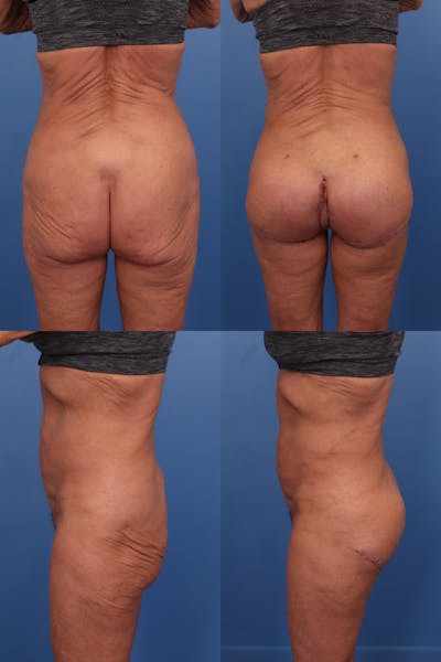 Buttock Augmentation with Implants Before & After Gallery - Patient 155570 - Image 1