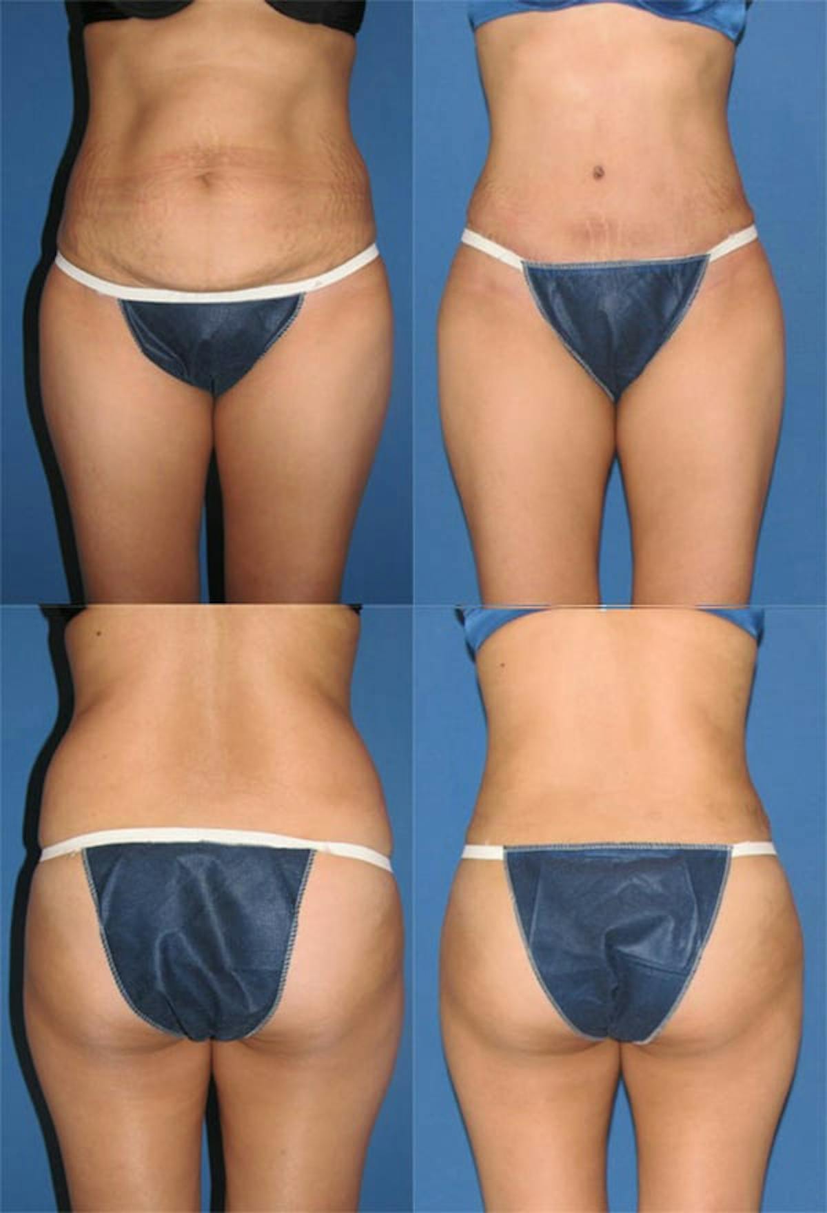Tummy Tuck Before & After Gallery - Patient 311103 - Image 1