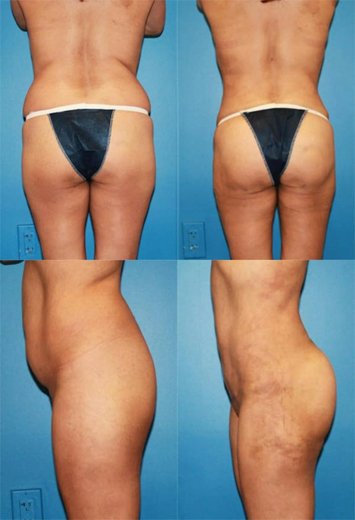 Brazilian Butt Lift Before & After Gallery - Patient 235323 - Image 1