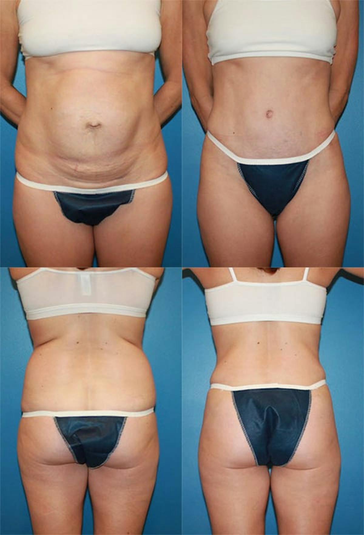 Tummy Tuck Before & After Gallery - Patient 272221 - Image 1