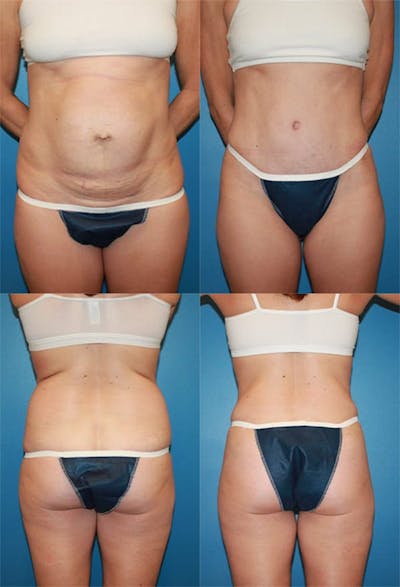 Tummy Tuck Before & After Gallery - Patient 272221 - Image 1