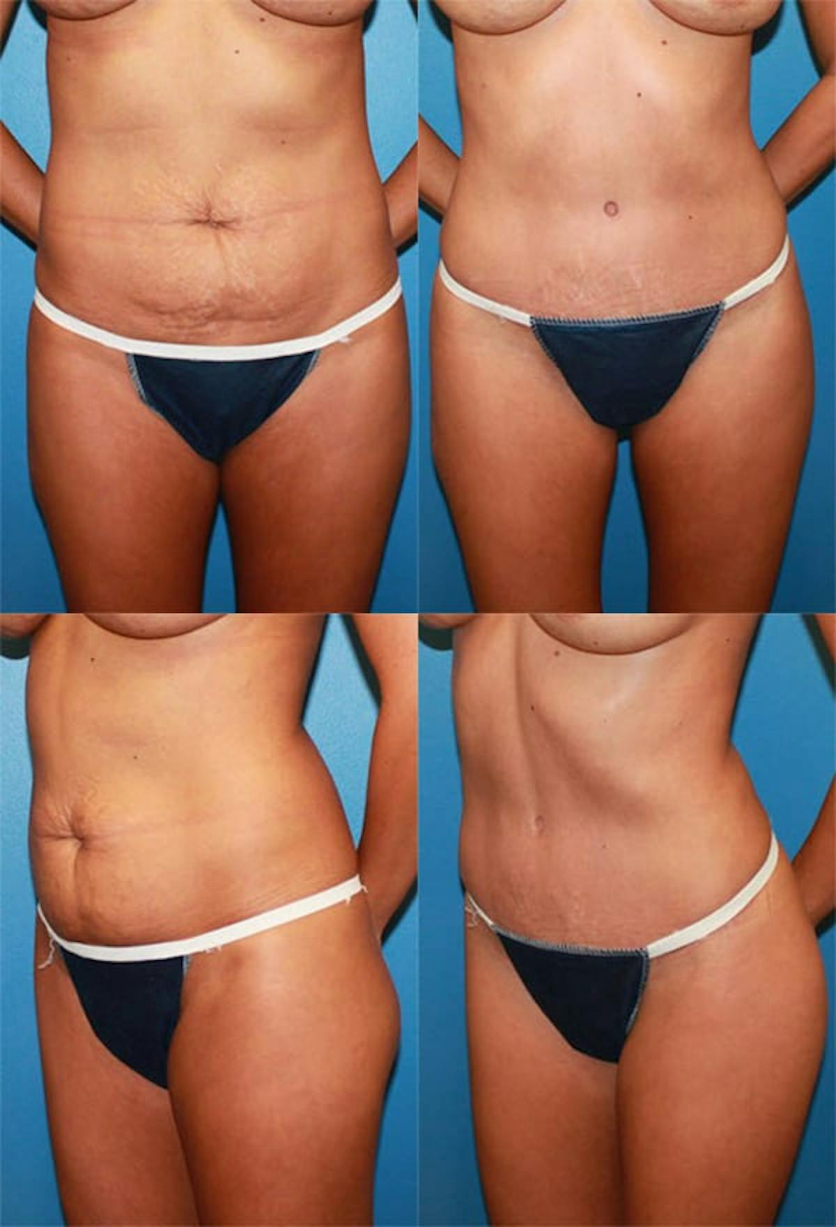 Tummy Tuck Before & After Gallery - Patient 379610 - Image 1