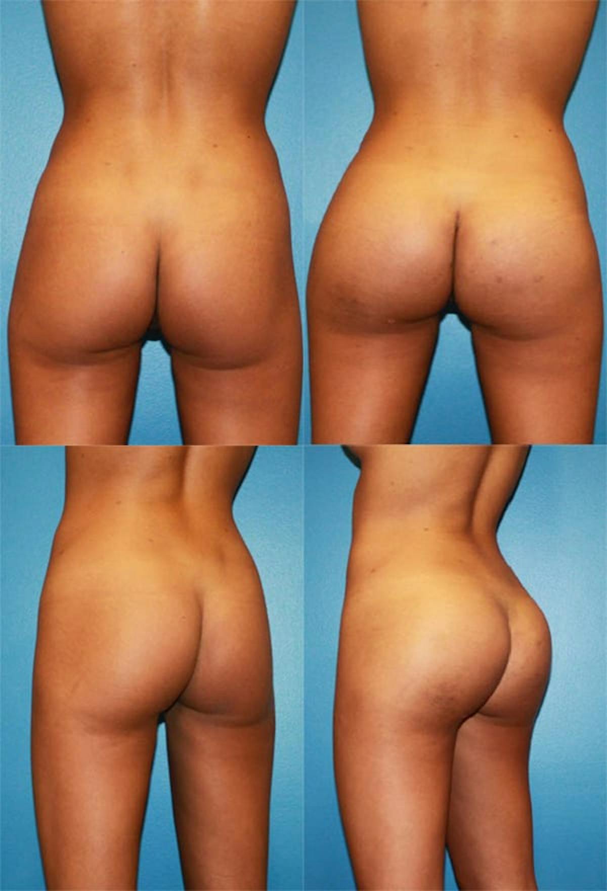 Buttock Augmentation with Implants Before & After Gallery - Patient 329546 - Image 1