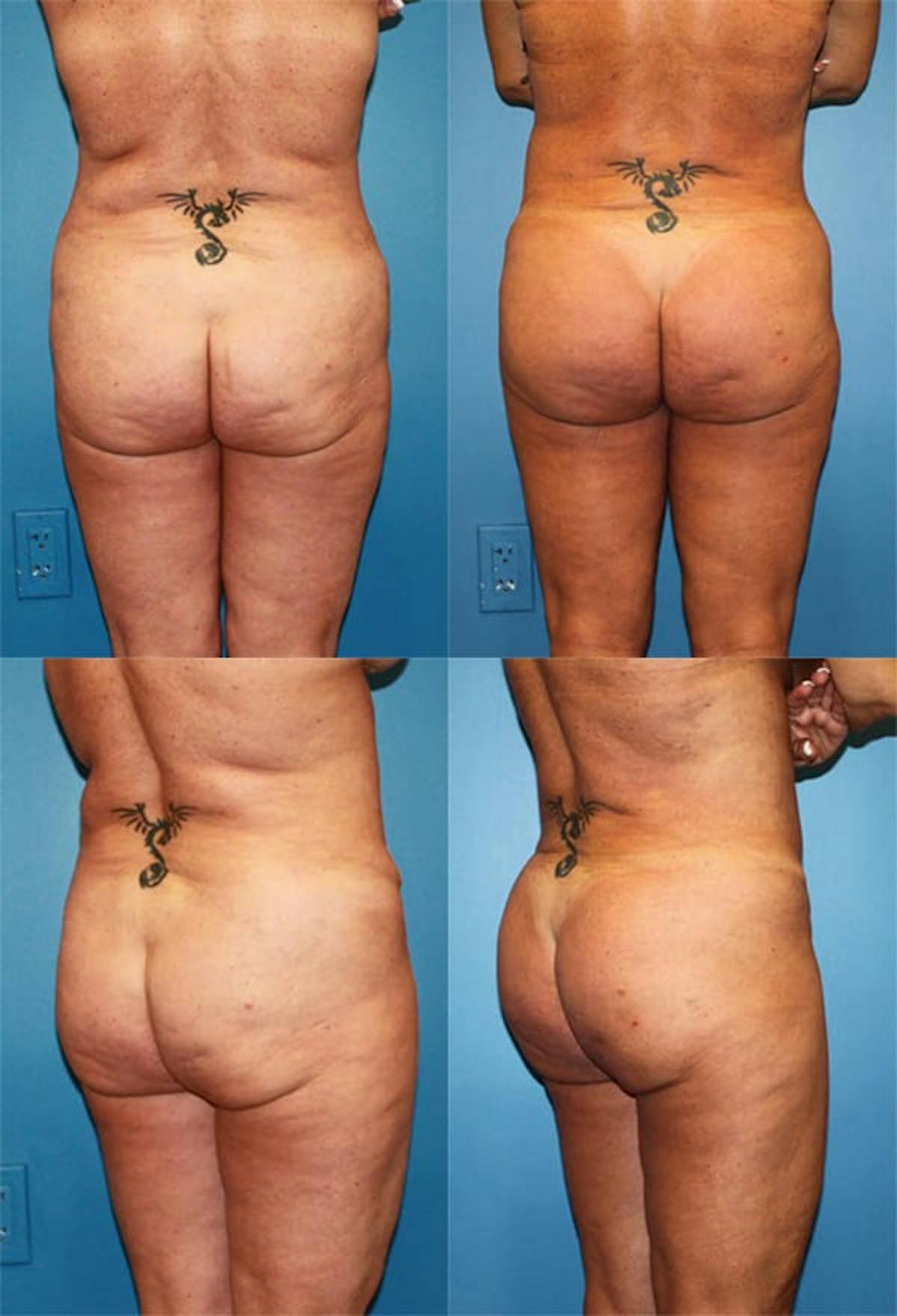 Thong Lift / Infragluteal Thigh Lift Before & After Gallery - Patient 410757 - Image 1