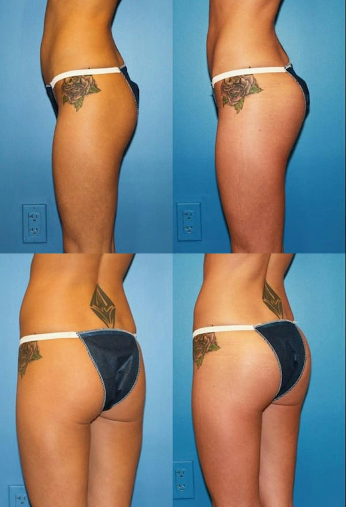 Buttock Augmentation with Implants Before & After Gallery - Patient 269096 - Image 1