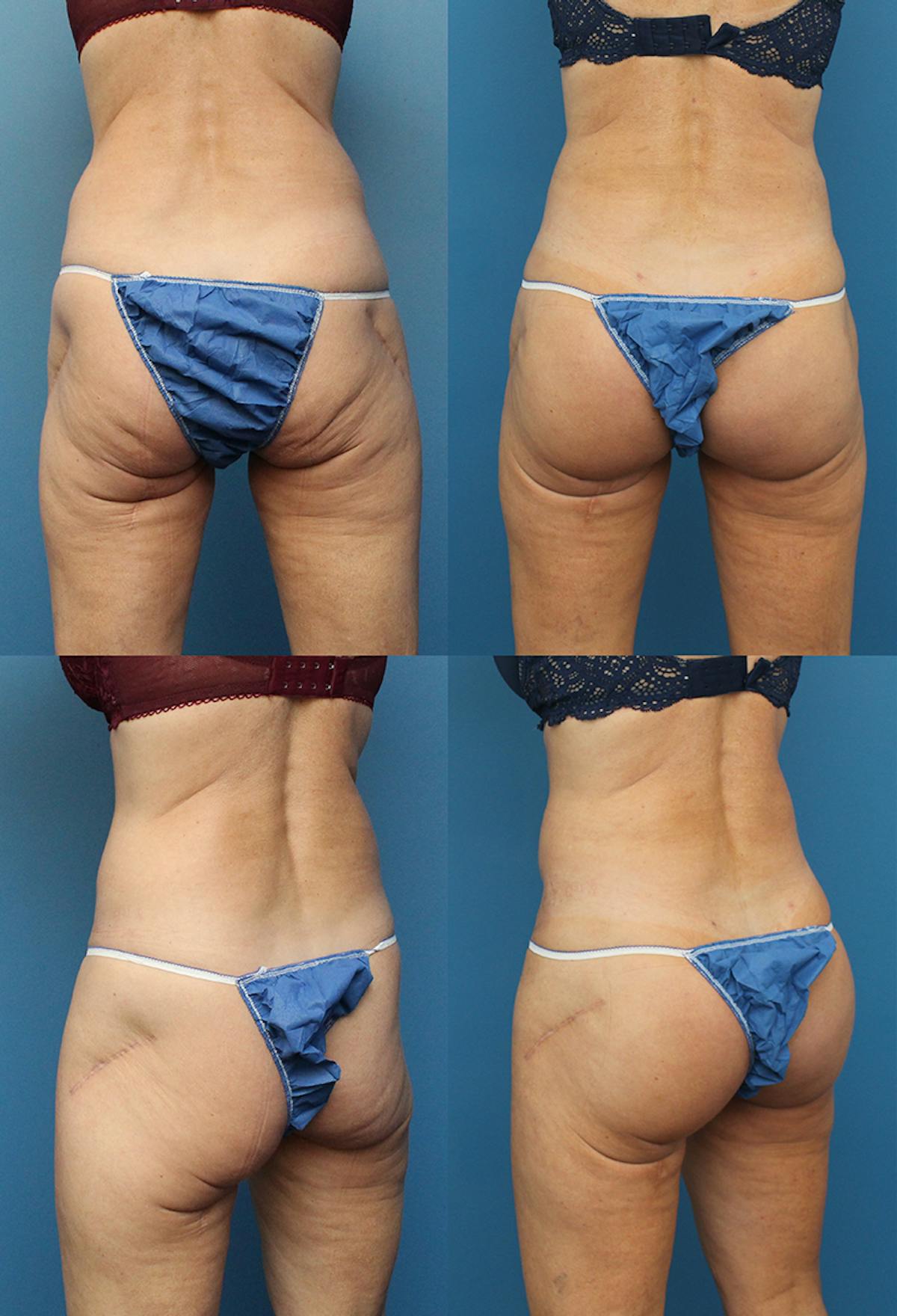 Buttock Augmentation with Implants Before & After Gallery - Patient 155898 - Image 1