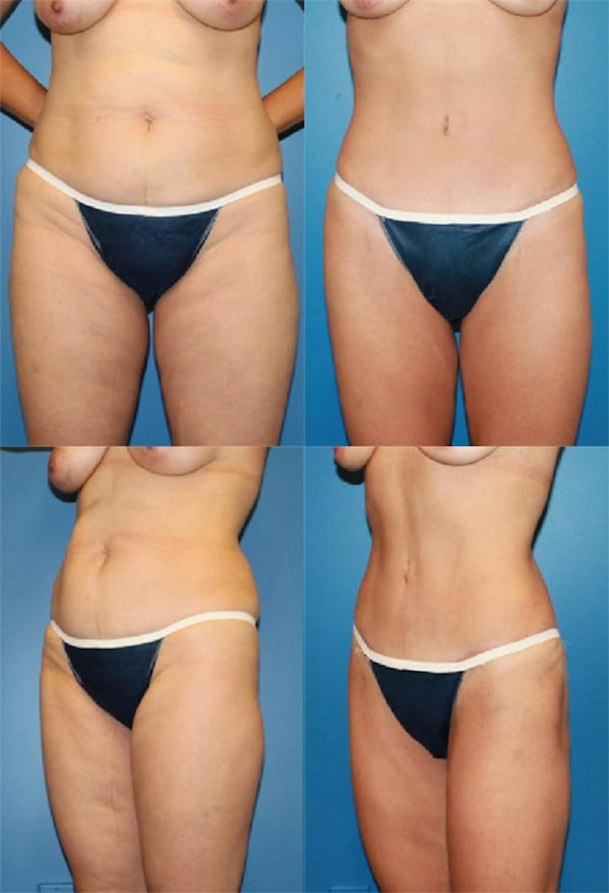Tummy Tuck Before & After Gallery - Patient 383909 - Image 1