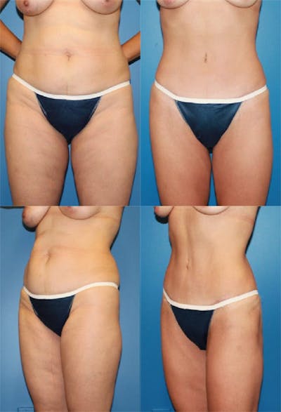 Tummy Tuck Before & After Gallery - Patient 383909 - Image 1