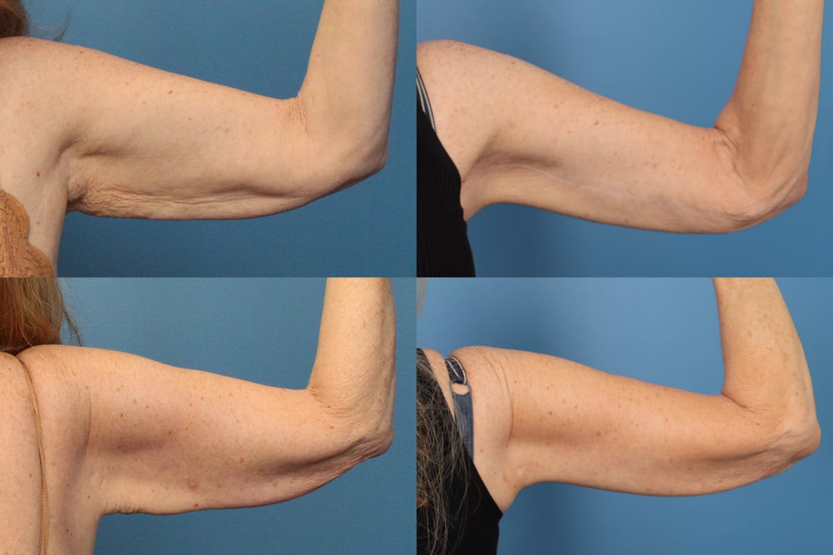Arm Lift Before & After Gallery - Patient 337002 - Image 1