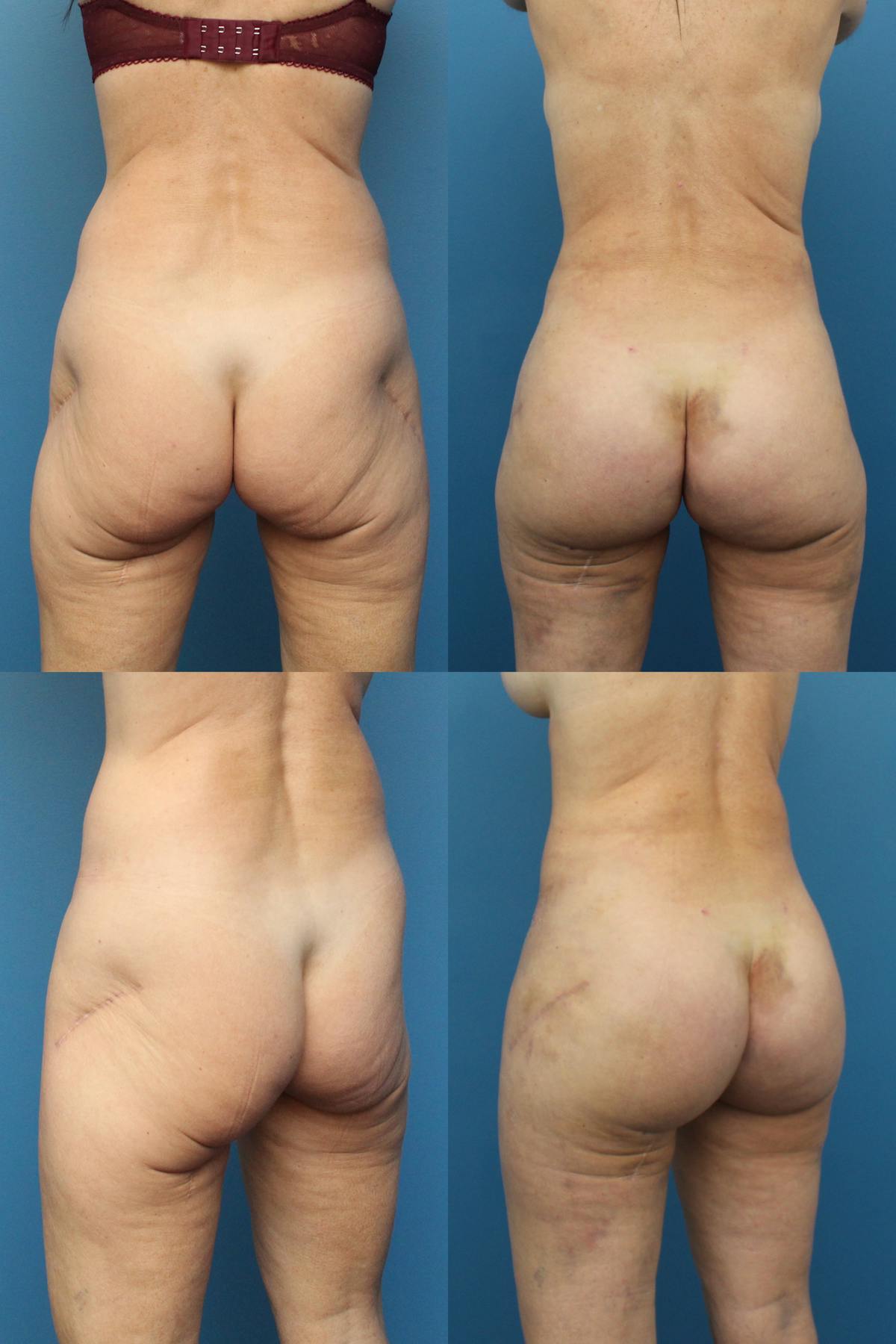 Buttock Augmentation with Implants Before & After Gallery - Patient 209178 - Image 1