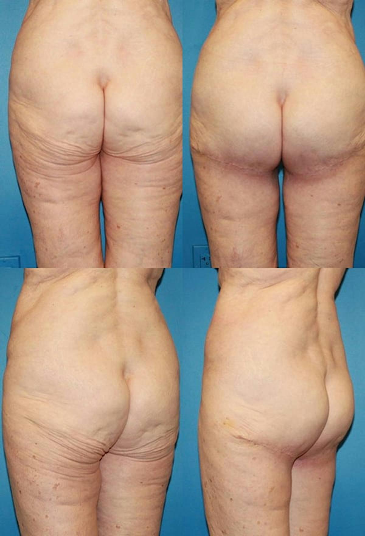 Thong Lift / Infragluteal Thigh Lift Before & After Gallery - Patient 222993 - Image 1