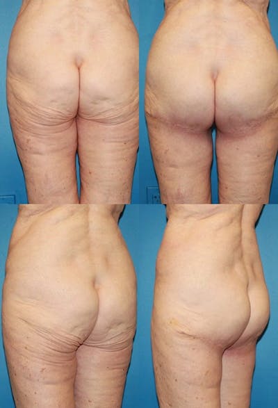 Thong Lift / Infragluteal Thigh Lift Before & After Gallery - Patient 222993 - Image 1