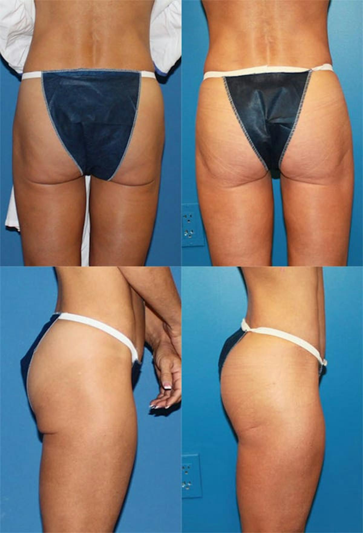 Thong Lift / Infragluteal Thigh Lift Before & After Gallery - Patient 280024 - Image 1