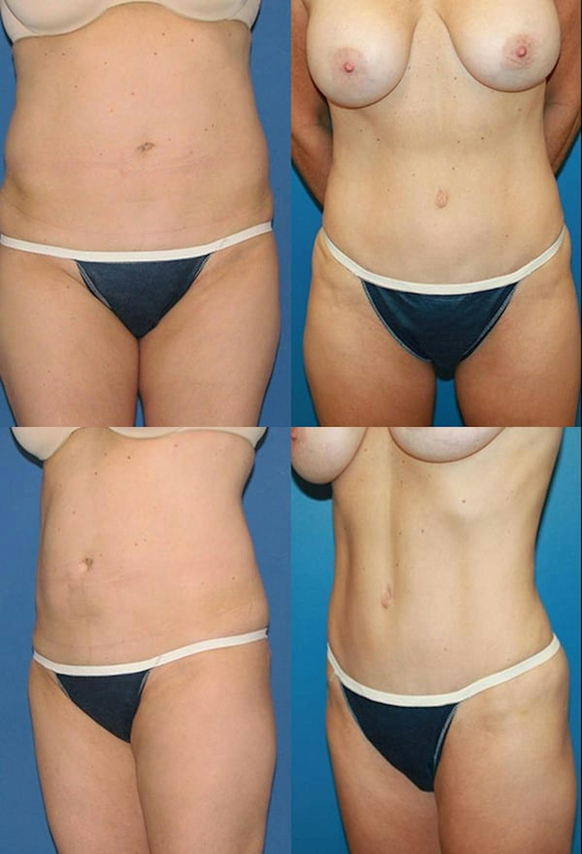 Tummy Tuck Before & After Gallery - Patient 165351 - Image 1