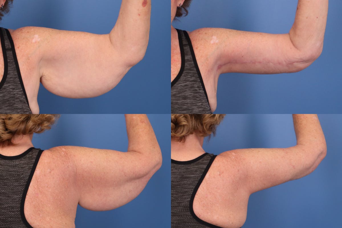 Arm Lift Before & After Gallery - Patient 346646 - Image 1