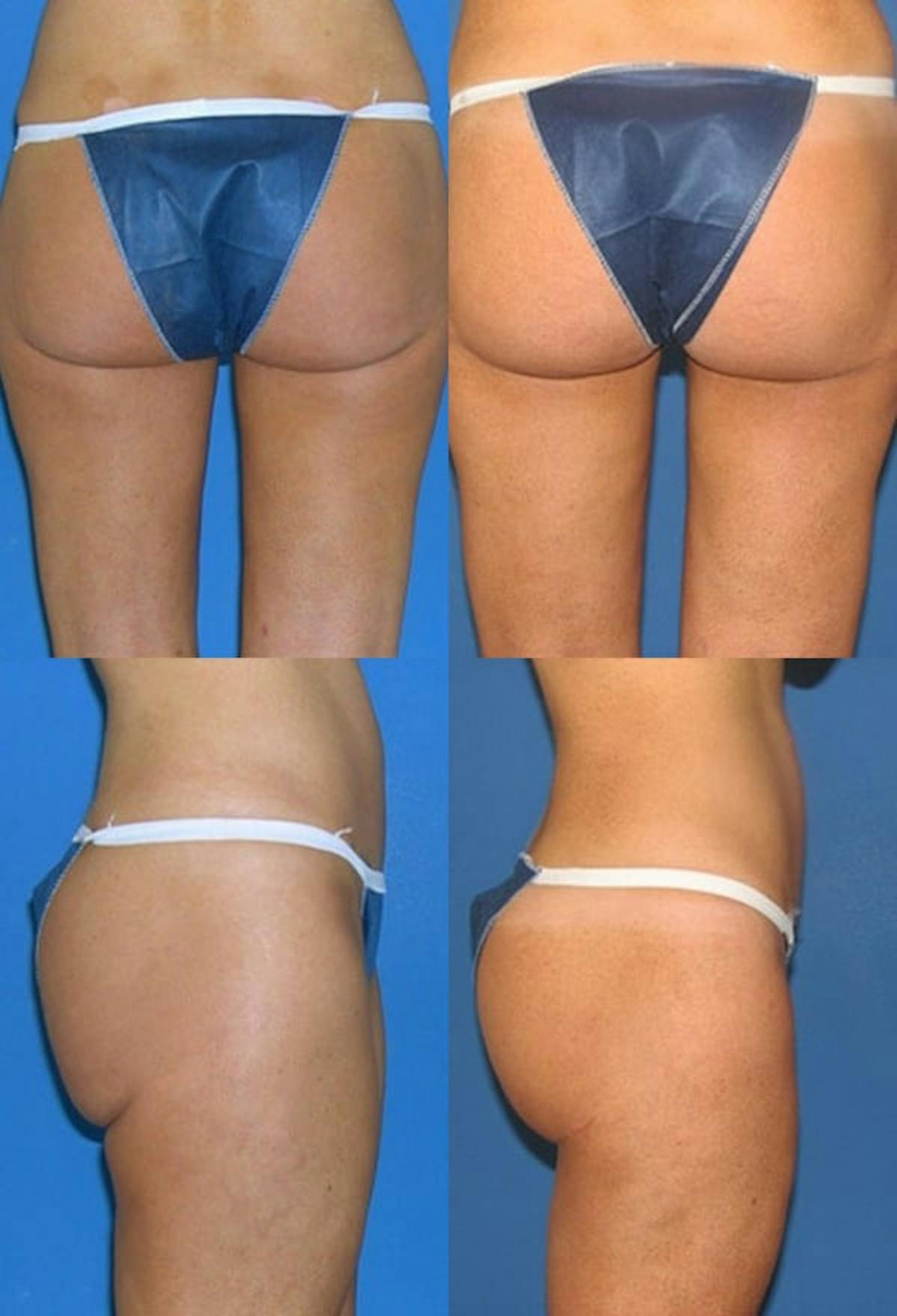 Thong Lift / Infragluteal Thigh Lift Before & After Gallery - Patient 146630 - Image 1