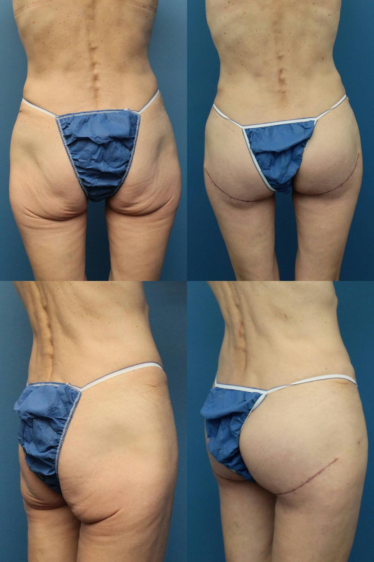Buttock Augmentation with Implants Before & After Gallery - Patient 416818 - Image 1
