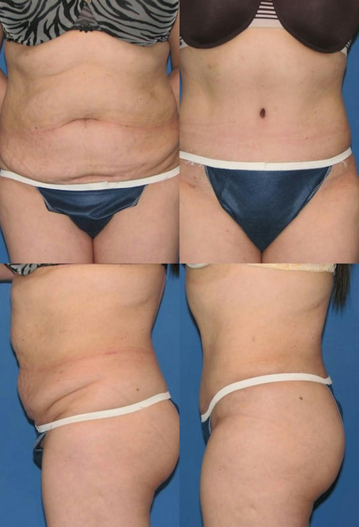 Tummy Tuck Before & After Gallery - Patient 270971 - Image 1