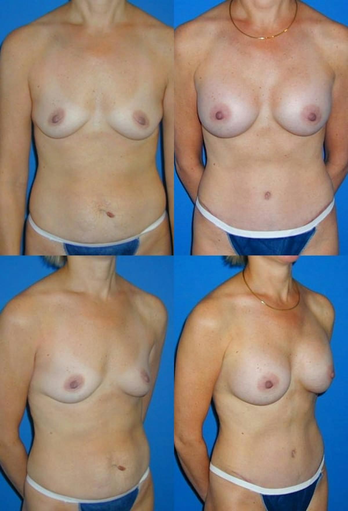 Tummy Tuck Before & After Gallery - Patient 126240 - Image 1