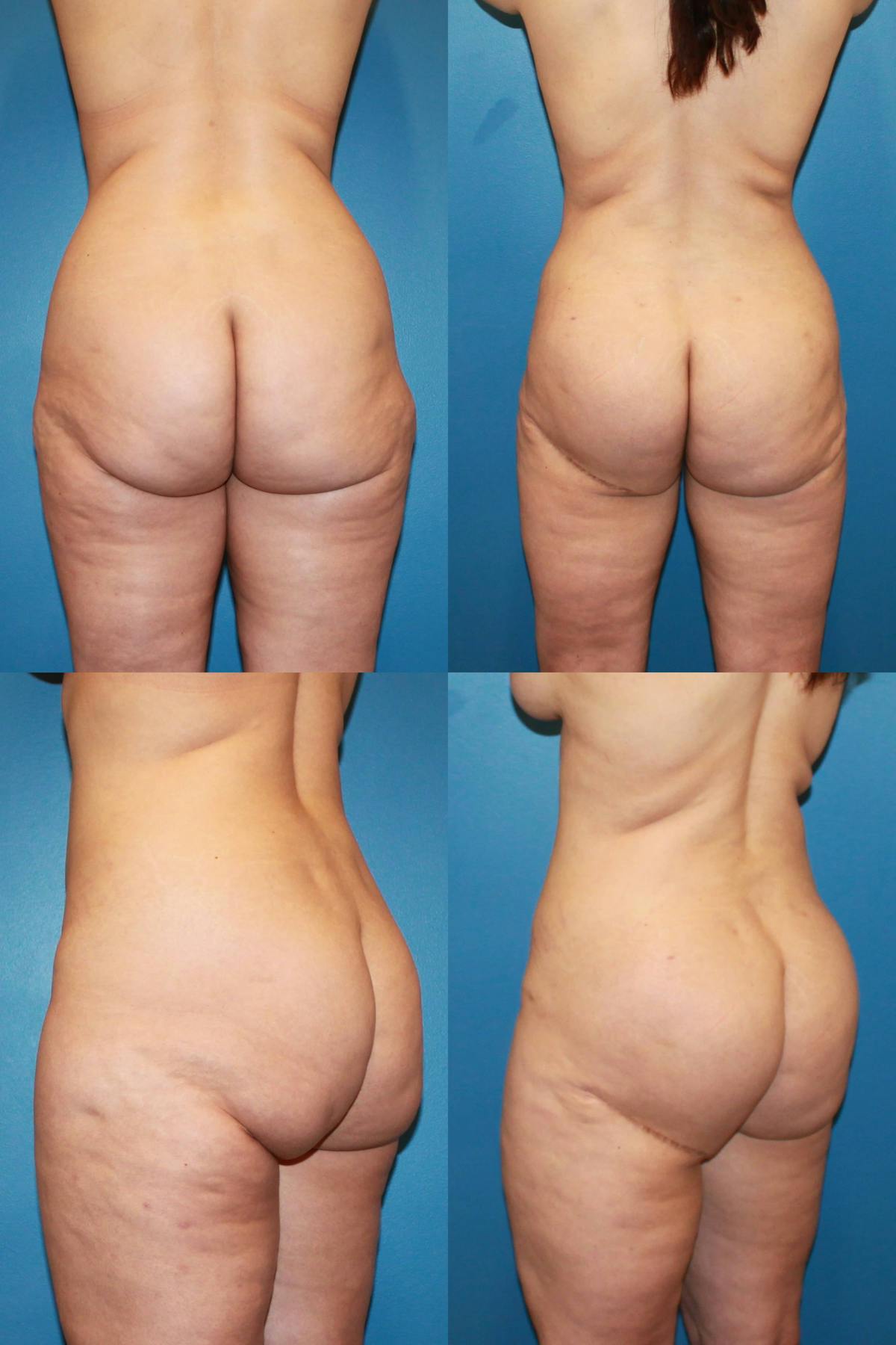 Thong Lift / Infragluteal Thigh Lift Before & After Gallery - Patient 163357 - Image 1