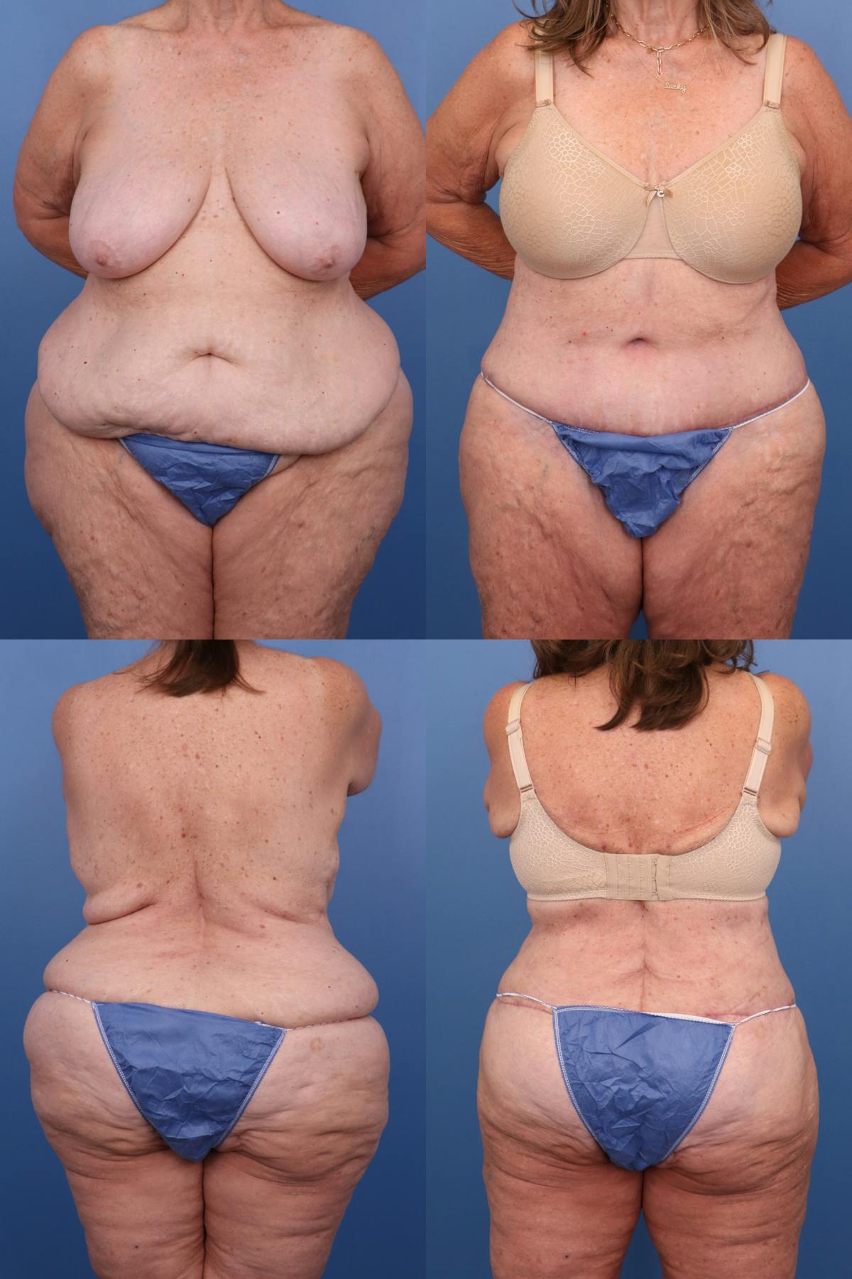 Body Lift / Thigh Lift Before & After Gallery - Patient 304998 - Image 1