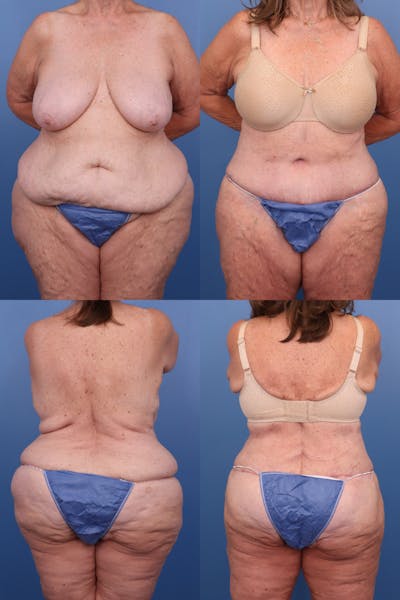 Body Lift / Thigh Lift Before & After Gallery - Patient 304998 - Image 1